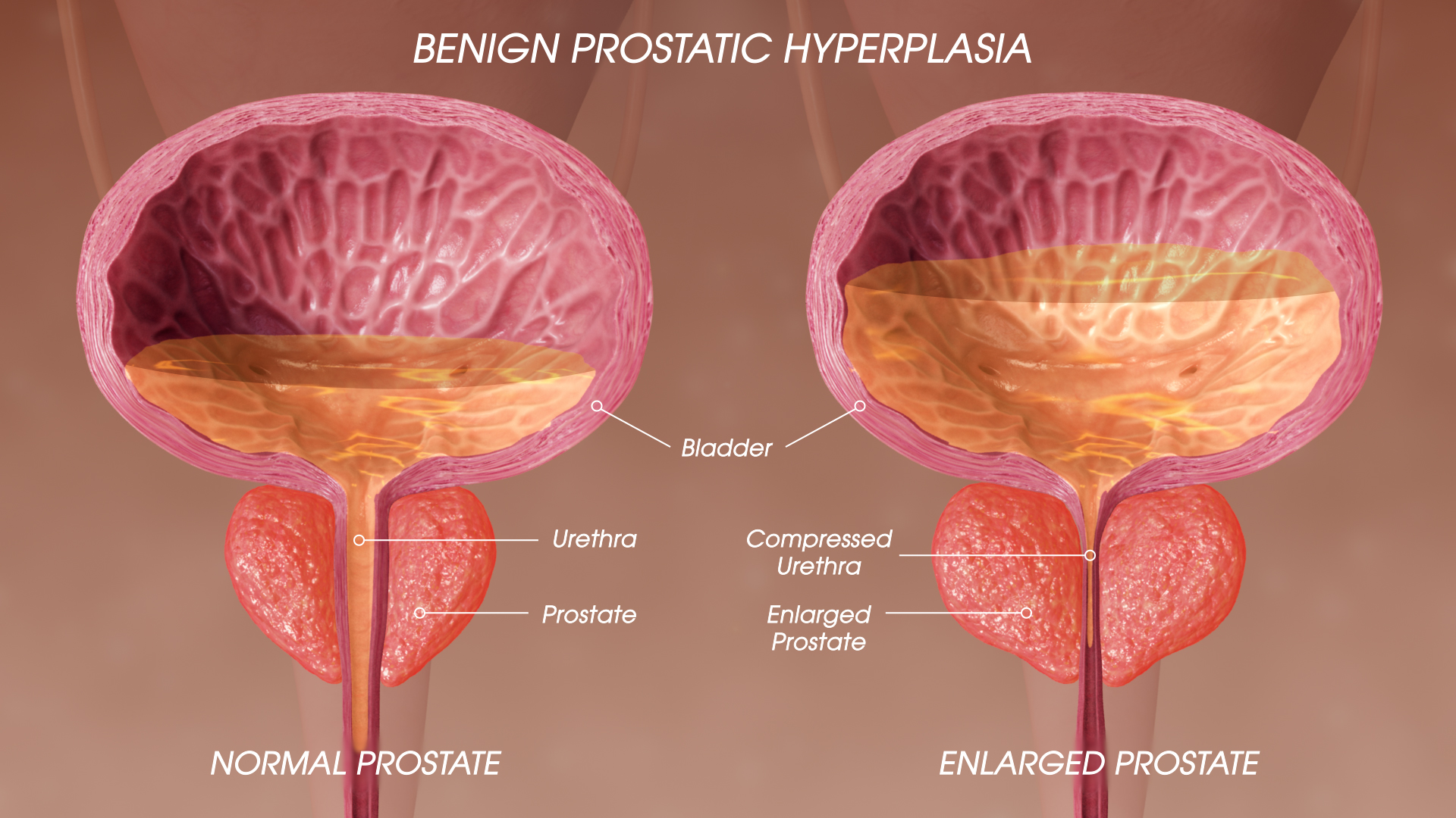 Ipertrofia Prostatica Benigna