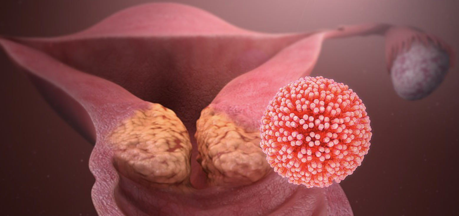 HPV (Papilloma Virus) nella Donna